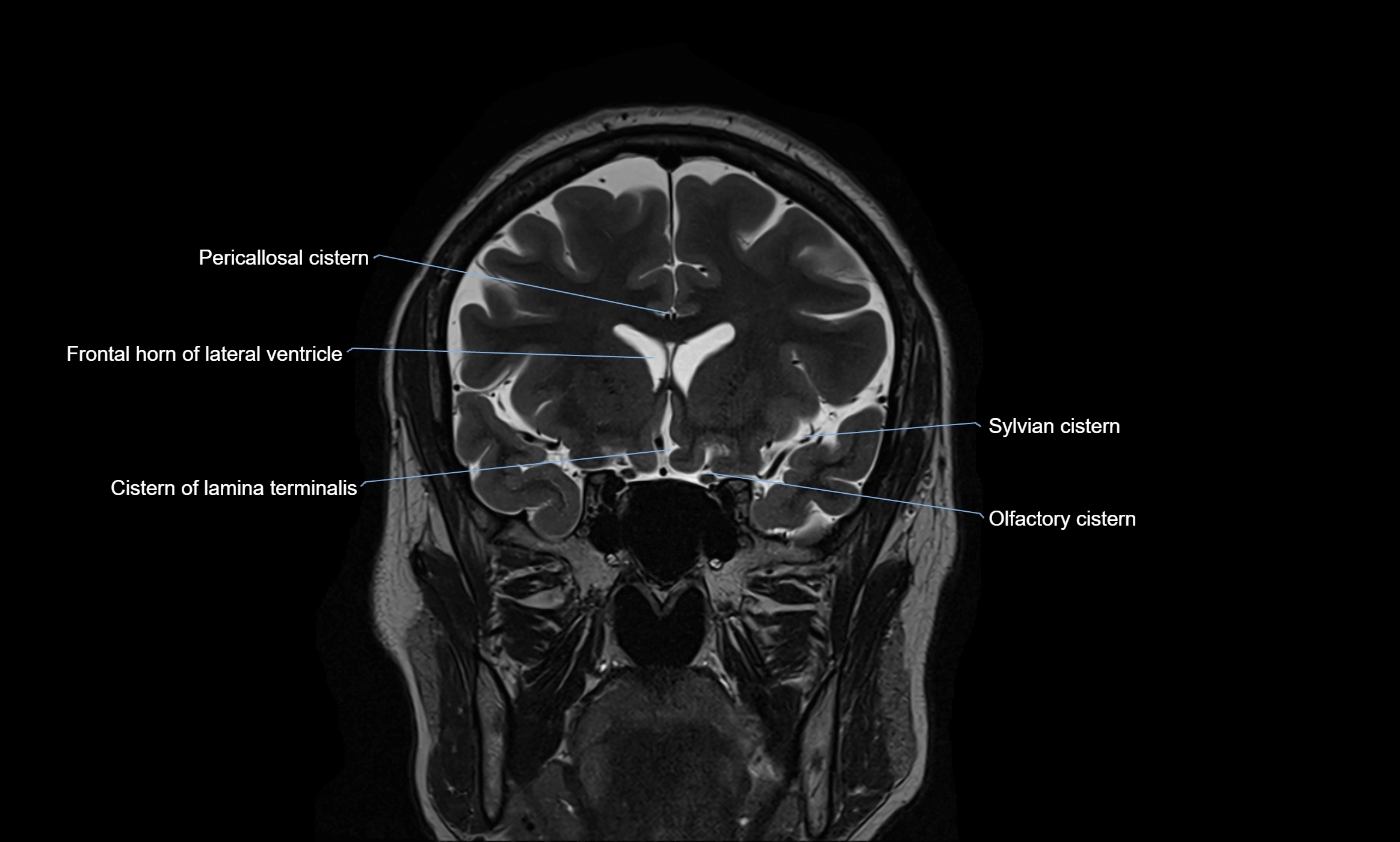 Brain cisterns  and ventricles coronal anatomy 3T MRI image-img-00001-00018.webp